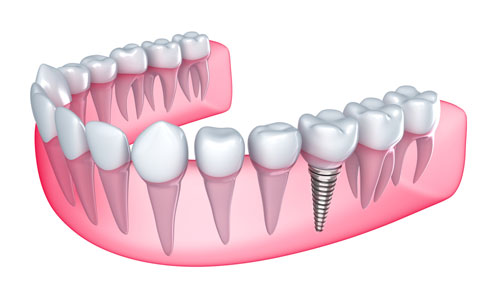 endodontics-mesa-az