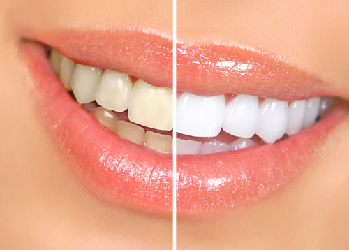 professional-teeth-whitening-ahwatukee-az