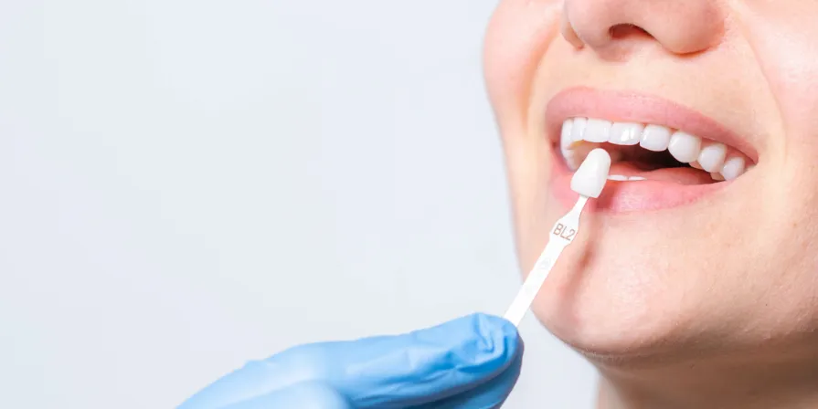 dental-veneers-tempe-az