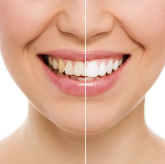 professional-teeth-whitening-tempe-az