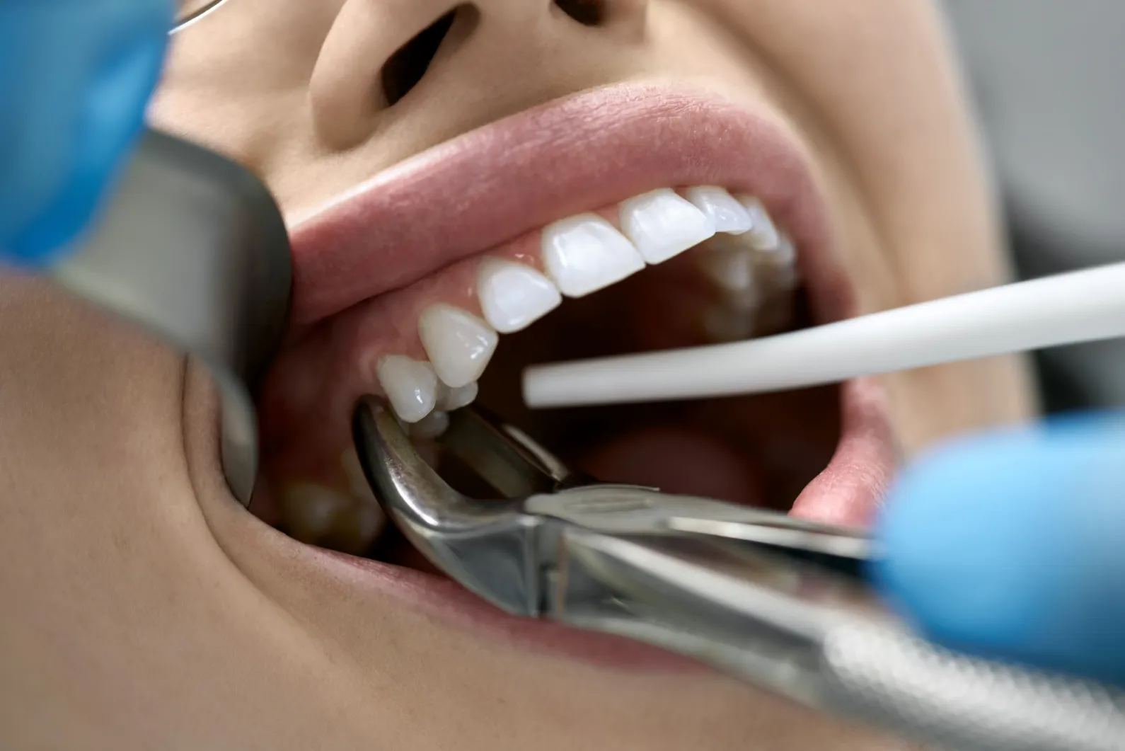 root-canal-procedure-tempe-az